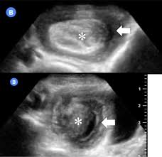 Convenientmd urgent care locations near milford, nh. Evaluation Of A Novel Handheld Point Of Care Ultrasound Device In An African Emergency Department The Ultrasound Journal Full Text
