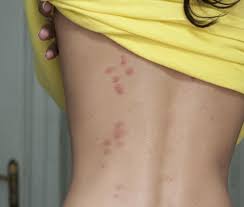 As last resort, dust or spray with. Getting Rid Of Bed Bugs Natural Measures Chemicals And Pest Control