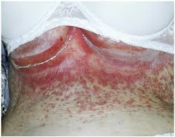 L'intertrigo est une forme de mycose de la peau qui touche les plis cutanés. Intertrigo The Wrong Bra Size Could Be The Main Cause Of This Infection Berg Intimates
