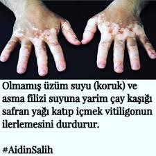 507 Begenme 7 Yorum Instagram Da Guzellik Dunyasi Ciltbakimi Ve Diyet Aidinsalih Vitiligo Sifa Corekotuyagi Ibnisina Beslenme Taze In 2020 Okay Gesture