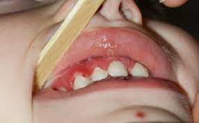 Gum Disease Gingivitis In Children Pediatric Dental Specialist