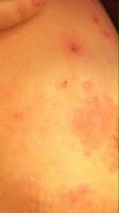 Ibc tends to grow and spread quickly, with symptoms worsening within days or even hours. Breast Cancer Topic Rash Awaiting Biopsy Results Scared