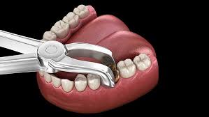 How To Stop Bleeding After Tooth Extraction Omega Dental Houston Tx