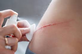 Image result for Wound