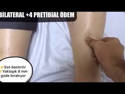 Pretibial Odem Nedir Hasta Uzerinde Nasil Bakilir Youtube