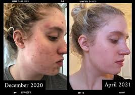 Skincare solutions for acne and aging issues