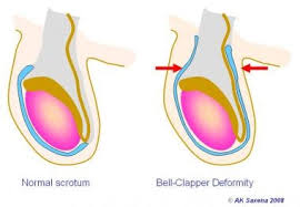Once the child reaches puberty and the size of the testes increases, the condition goes away. Manual Detorsion Of The Testes Overview Indications Contraindications