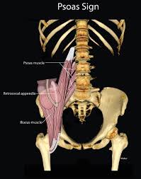 Image result for Psoas Sign