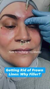 Tired of looking angry? For my patients with deeper frown lines, I often  first do neurotoxin (think Botox, Jeaveau, Xeomin, Dysport, Daxxify)