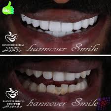 لعبة الثعلب و الارنب من العاب الاطفال الجميله التى نجد فيها حزن الثعلب على صديقه الارنب و الغريب ان الثعلب هو من قام باكل الارنب ثم قام بدفنه و عندما استفاق و تذكر ما. ØªØ¬Ù…ÙŠÙ„ Ø§Ø³Ù†Ø§Ù† Ø§Ù„Ø§Ø±Ù†Ø¨ Sharjah Uae