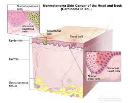 In some cases, the tumor can have features of both and are called mixed. Skin Cancer Types Symptoms Information Dana Farber Cancer Institute Boston Ma
