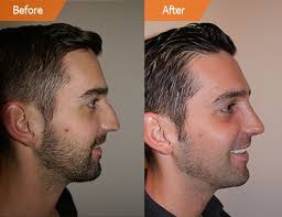 Updated april 21, 2021 to include recent cost data. Rhinoplasty Cost Nyc Nose Job Cost New York