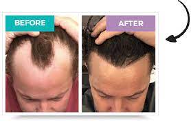 The first 2 weeks after the hair transplant are the most critical ones. How Long Does It Take To Recover From Hair Transplant Quora