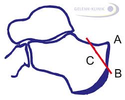 Een haglundse exostose is een botuitsteeksel aan de achterzijde van het hielbeen. Haglundferse Entstehung Ruckbildung Therapie Gelenk Klinik De