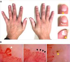 Image result for Systemic Sclerosis