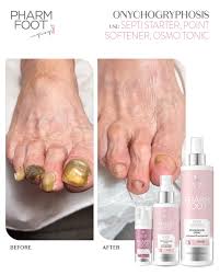 Image result for Onychogryphosis feet