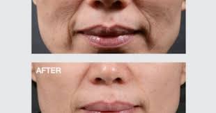 Intracel Dr Kamil Al Rustom Skin Laser Centre Laser Skin Skin Resurfacing Skin