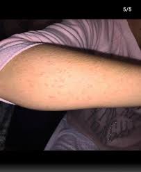 Daniela nicolás, miss chile, nos cuenta cómo se ha adaptado a la modalidad online para prepararse para miss universo y se sincera sobre su enfermedad. Daniela Nicolas Tal Cual Es Muestra Las Manchas Que Le Han Dejado Su Enfermedad Autoinmune