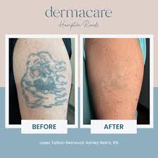Removery Tattoo Removal & Fading – Camp Creek