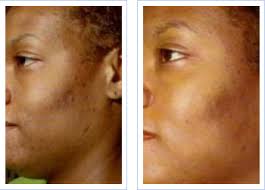 Check spelling or type a new query. Beverly Hills Glycolic Acid Chemical Skin Peel Treatments Skin Renewal System With Neostrata Jessner S Peel By Visual Changes