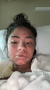 Denial of SSDI benefits after multiple brain surgeries and seizures