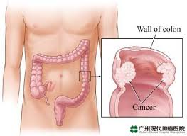 Nyeri perut kanan bawah juga dapat disebabkan oleh penyakit batu ginjal. Gejala Kanker Usus Besar Rumah Sakit Tumor Modern Guangzhou China