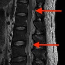 Image result for Spinal Epidural Abscess