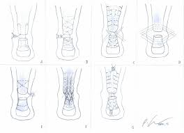 Superior biomechanical properties and tying time with the modified prusik knot and wittstein suture loop to the krackow stitch. Achilles Tendon Repair According To The Open Kessler A The Open Download Scientific Diagram