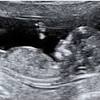 Nuchal scan (plural nuchal scans). 1