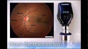 How to use a ophthalmoscope. Direct Ophthalmoscopy Youtube
