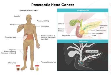 Fisiopatología Del Signo De Courvoisier-Terrier En El Cáncer De Cabeza De Páncreas, Generada Por Ia