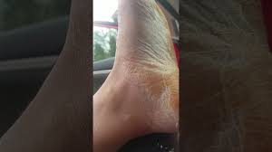 Peeling skin may be associated with a rash, taking certain medications, or burns. Cast Removal Skin Peeling Gross Youtube