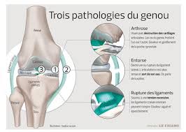 Elle augmente sur terrains vallonnés, quand on monte ou descend des. Douleur Du Genou Qu Est Ce Que C Est Fiches Sante Et Conseils Medicaux