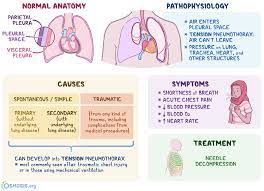Maybe you would like to learn more about one of these? Tension Pneumothorax What Is It Causes Signs Symptoms Diagnosis Treatment And More Osmosis