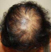 J investig dermatol symp proc. Finasteride And Its Potential For The Treatment Of Female Pattern Hair Loss Evidence To Date Scienceopen