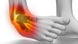 Lateral Ligament Ankle Sprain: How To Treat It Properly