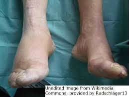 Find out information about charcot. Diabetischer Fuss Charcot Fuss Deximed