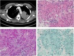 Image result for Rhodococcus equi