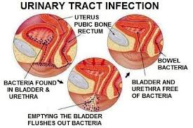 Urinary Tract Infection Uti Urinary Tract Infection Urinary Tract Infections