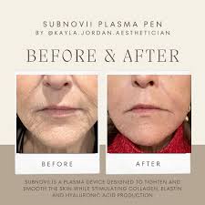 Stomach laxity? Subnovii's got you covered! ⚡️ Huge thanks to  @peakmedicalspa for showcasing how Subnovii Plasma Pen can help tighten  wrinkles and sagging skin
