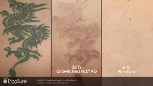 We use the newest technology in a non med spa environment. Virtually Painless Laser Tattoo Removal Camp M D Aesthetics Dr Jeffrey Camp