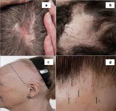 Get the facts about sarcoidosis from webmd. Alopecia In General Medicine Rcp Journals