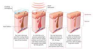 Ideal for both men and. Laser Hair Removal Melbourne Ipl Hair Removal Brunswick