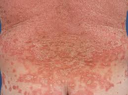 Pityriasis rubra pilaris or prp presents clinically as a papulosquamous eruption with follicular plugging and perifollicular erythema. Pityriasis Rubra Pilaris Causes Signs Symptoms Diagnosis Treatment