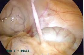 Image result for Umbilicus botryoides