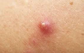 Penyebab bisul adalah infeksi bakteri staphylococcus aureus. 7 Bahan Alami Yang Aman Dan Efektif Untuk Mengobati Bisul