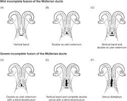 We did not find results for: Severe Incomplete Fusion Of The Mullerian Ducts Influences Reproduction In Holstein Cattle Sciencedirect