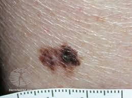 When malignant cancer cells form and grow within a person's breast tissue, breast cancer occurs. Skin Cancer In People Of Color Statistics Pictures And Prevention Goodrx