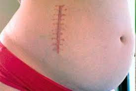 Een blindedarmontsteking is een ontsteking van de appendix, waardoor het kan scheuren. Appendicitis Tijdens De Zwangerschap Symptomen Behandeling Competent Over Gezondheid Op Ilive