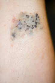 Image result for Blue Nevus